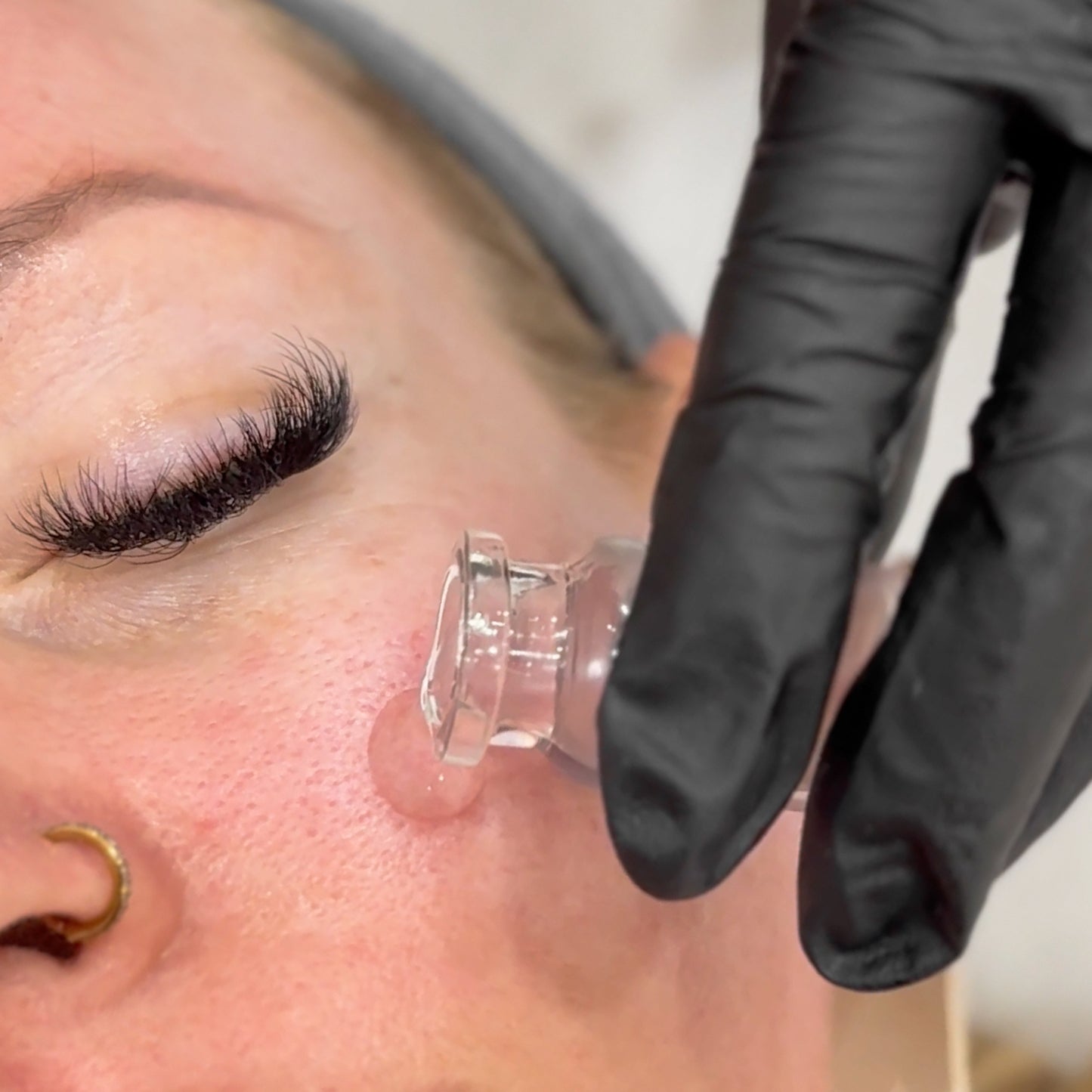 Exosome Treatment Add-On