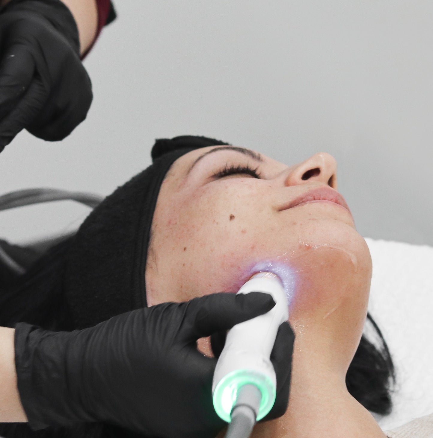 RF TempSure Skin Tightening  - 3 Pack (Full Face)