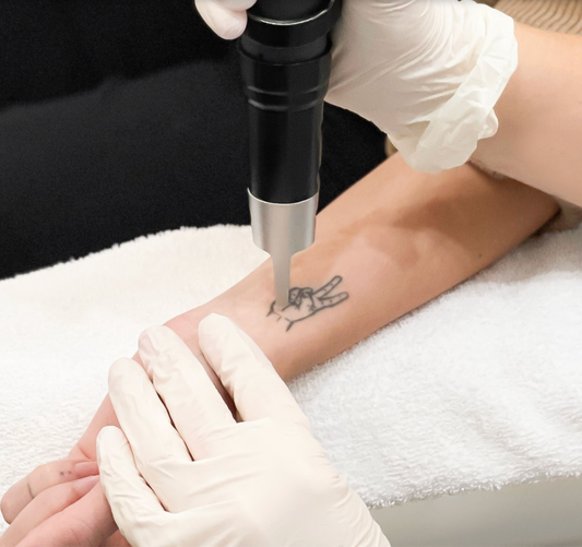 Laser Tattoo Removal (3-Pack) – Size: 2” × 3.5”