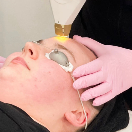 IPL Photofacial - Single